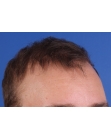 After Hair Transplant&nbsp;Front